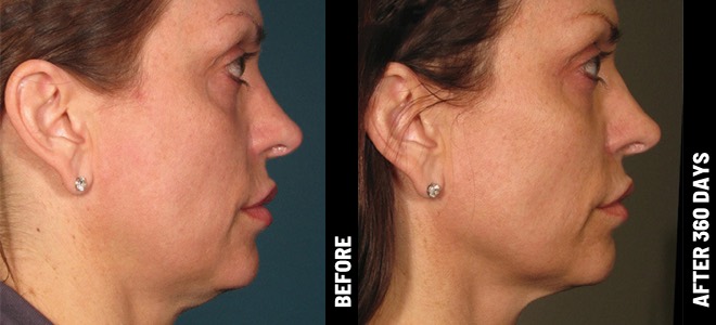 MORE PATIENT RESULTS 