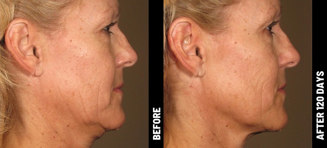 MORE PATIENT RESULTS 